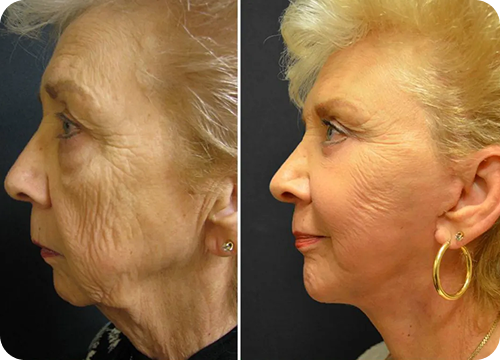 face and neck lift treatment 4