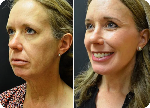 face and neck lift treatment 3
