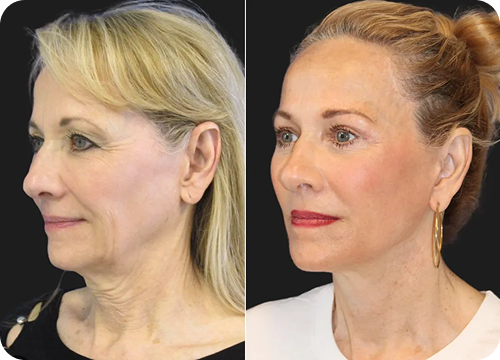 face and next lift treatment 1